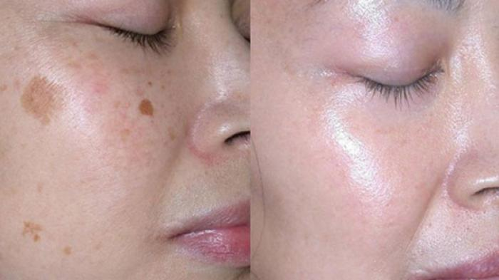 Waspada Pemutih Abal Abal Yang Ada Dipasaran