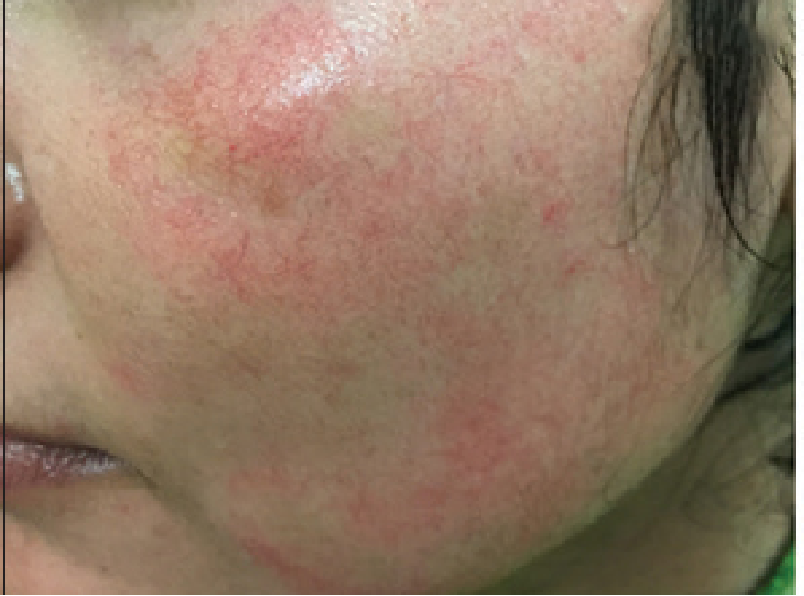 Inilah Bahaya Dari Cream Steroid