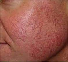 Inilah Bahaya Dari Cream Steroid