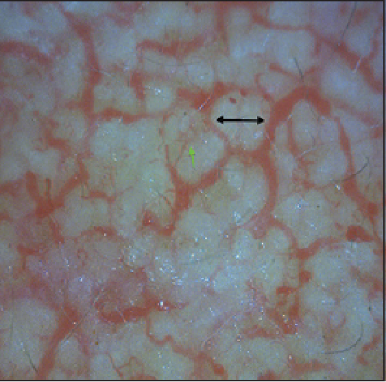 Inilah Bahaya Dari Cream Steroid