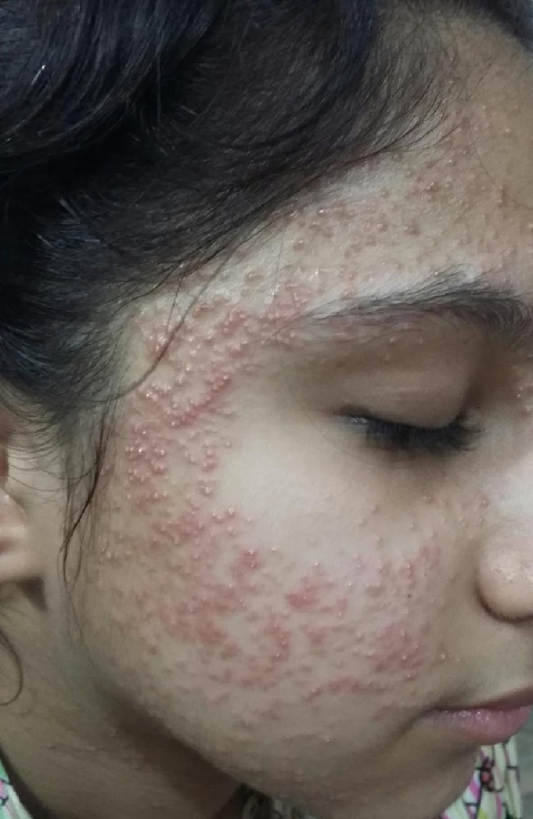 Inilah Bahaya Dari Cream Steroid