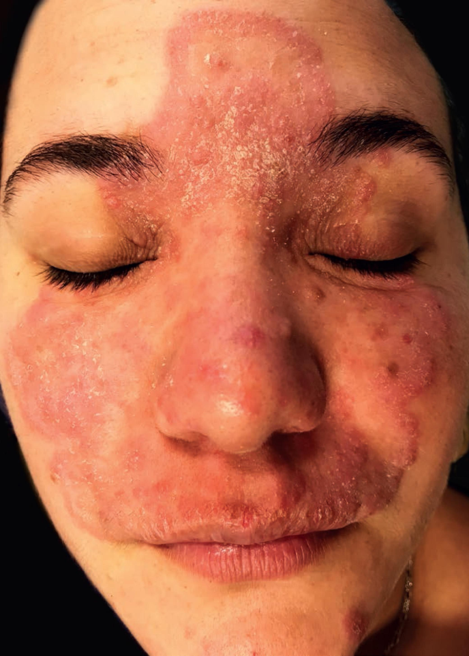 Inilah Bahaya Dari Cream Steroid